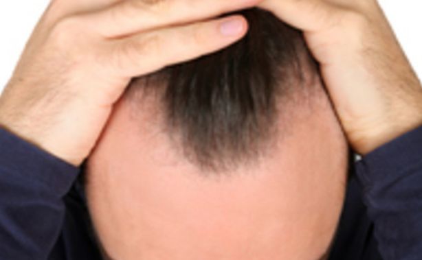 将来的にハゲがいなくなるかも